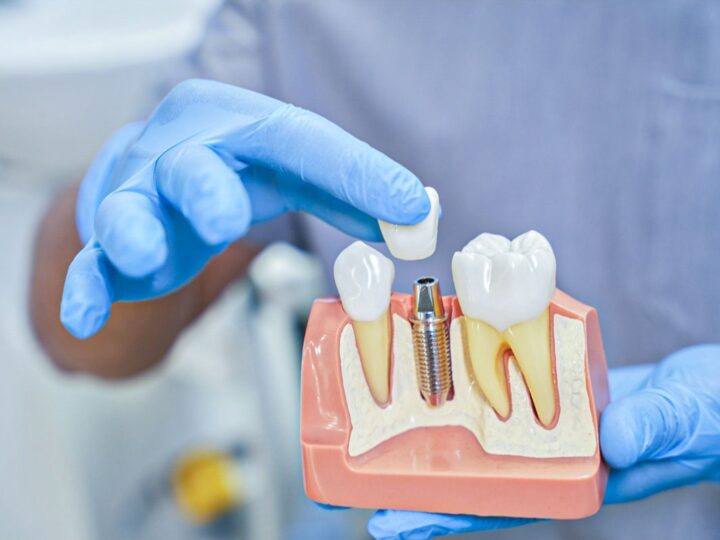 Hollywoodzki uśmiech. Jak implanty odtwarzają naturalne piękno zębów?