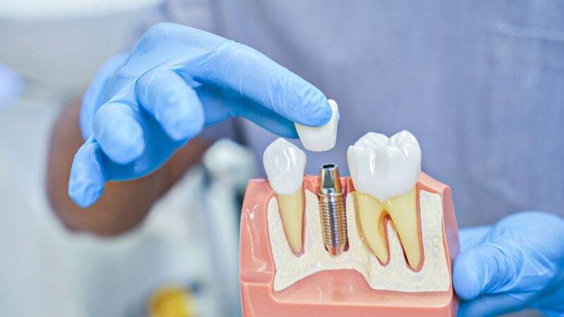 Hollywoodzki uśmiech. Jak implanty odtwarzają naturalne piękno zębów?