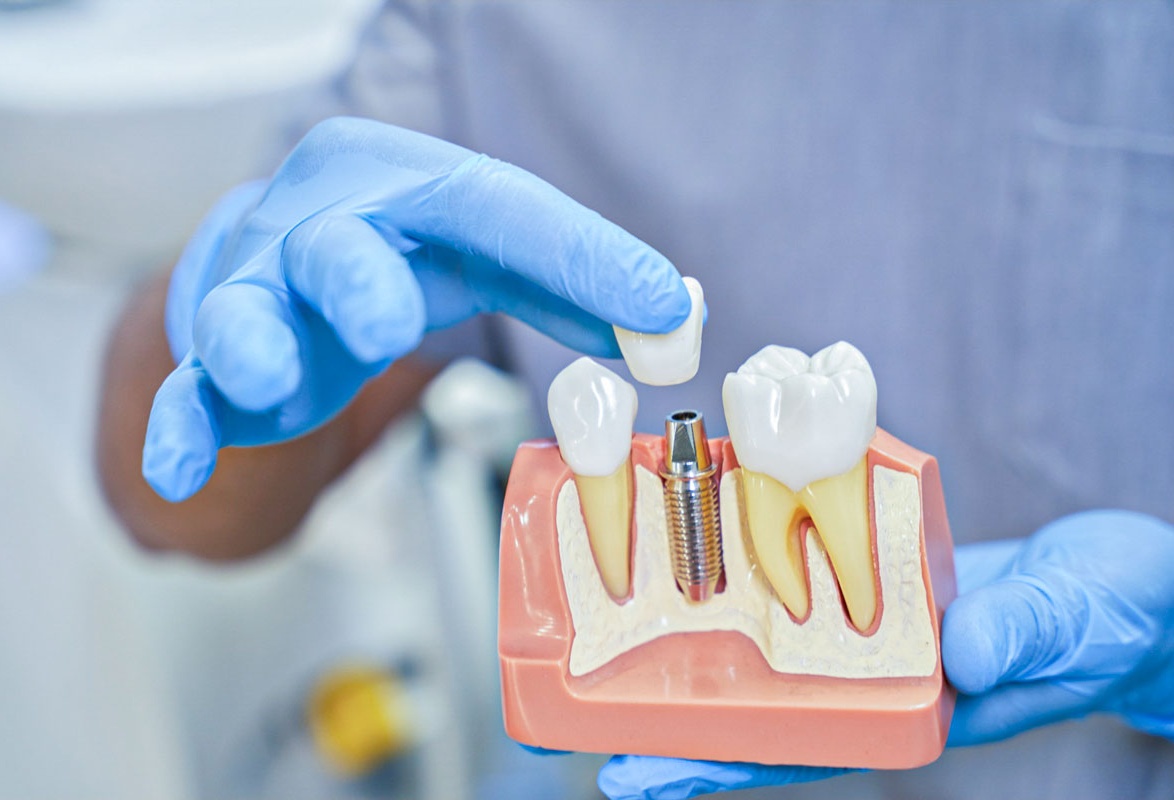 Hollywoodzki uśmiech. Jak implanty odtwarzają naturalne piękno zębów?